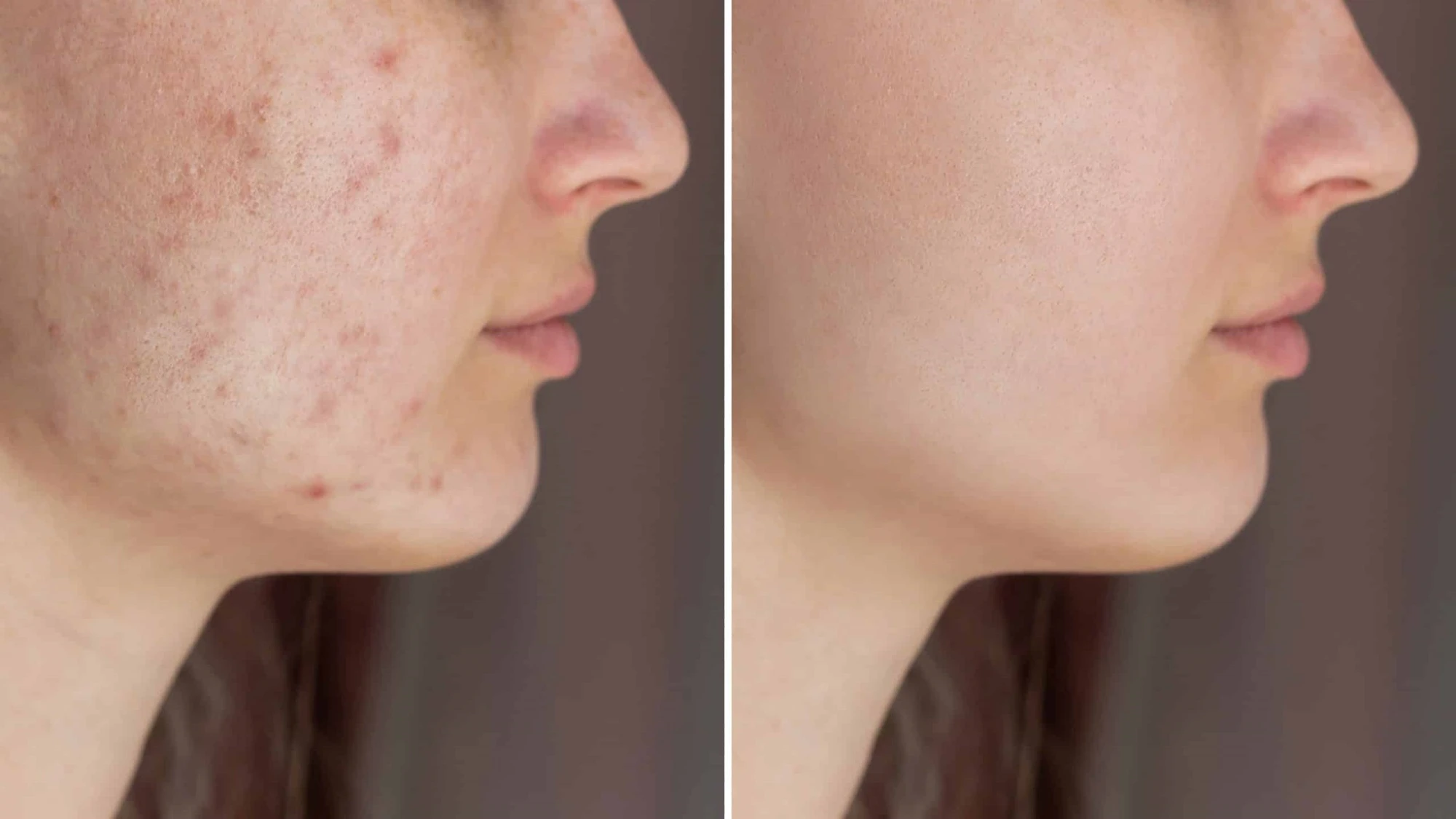 Dealt With Melasma | Aspire Aesthetics and Wellness